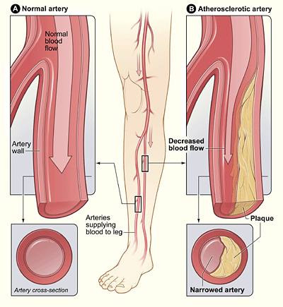 Normal Artery and Artery With Plaque Buildup