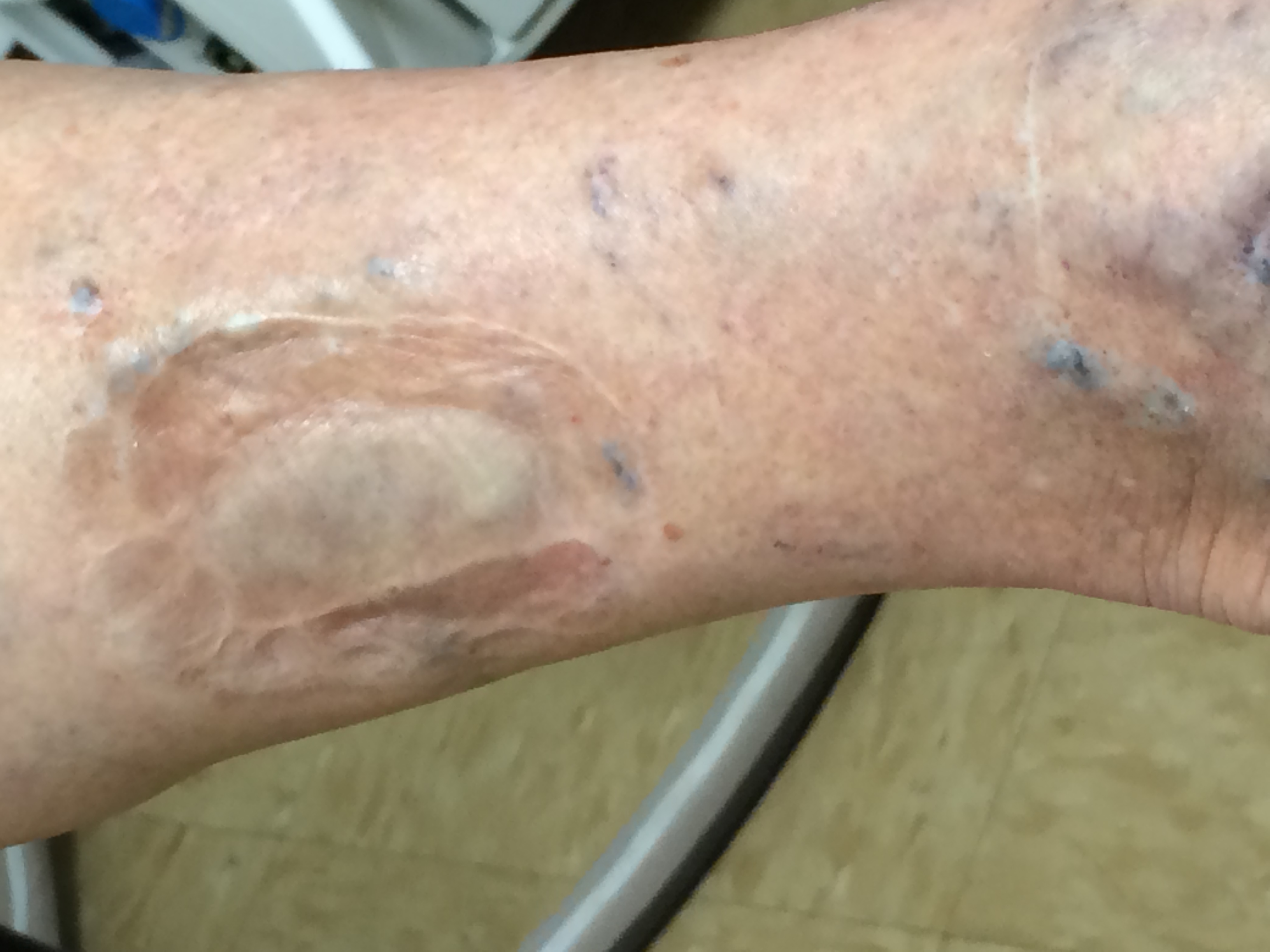 Healed Venous Stasis Ulcer Healed Venous Stasis Ulcer