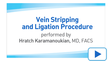 Vein Stripping Technique Vein Stripping Technique